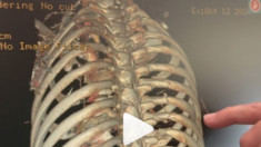Cam Zink Injury Update - Lots of Broken Ribs!